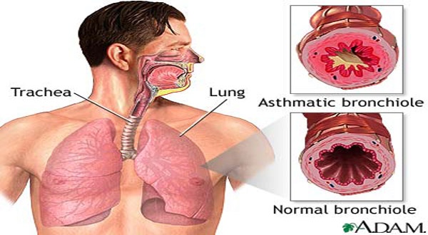 Some Alternative Approaches to Bronchial Asthma