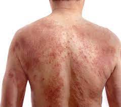 Dr. Naval Parikh: Allergy Types, Causes, Symptoms & Treatment