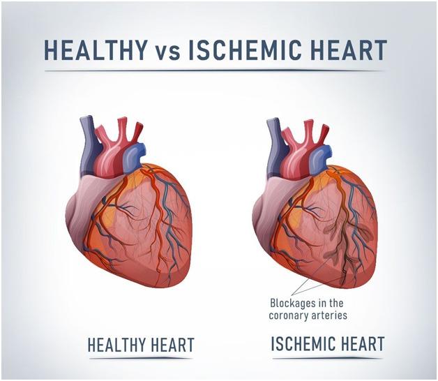 Ischemic Heart Disease: Symptoms, Causes, and risk factors
